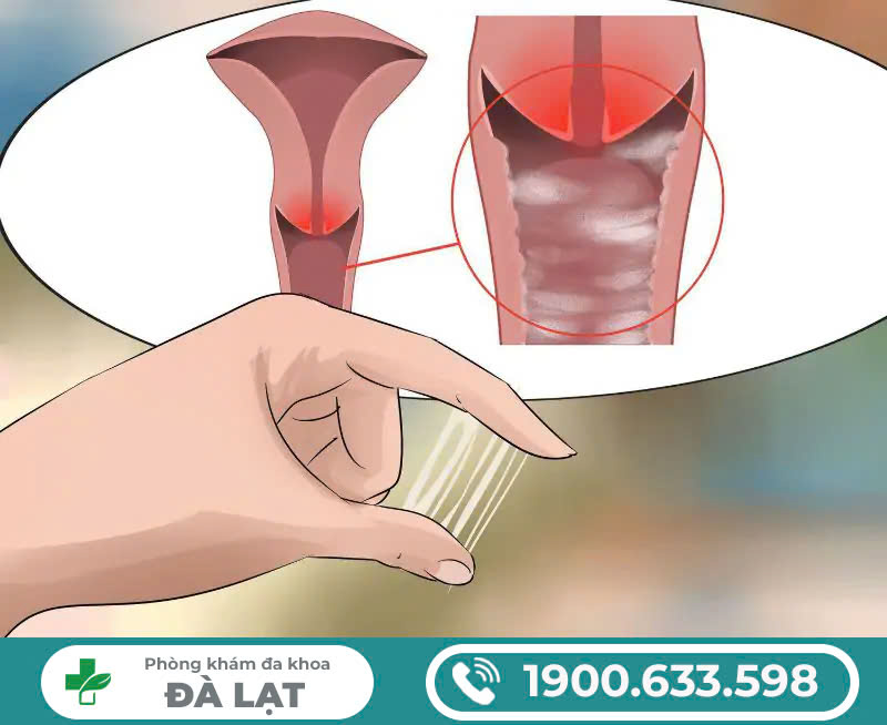 CÁC CÁCH CHỮA VIÊM CỔ TỬ UNG HIỆU QUẢ 